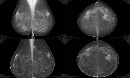 Mammografi